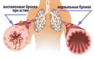 Последствия передозировки дексаметазоном