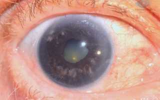 Глаукома: формы, симптомы, причины и способы лечений