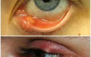 Эффективные мазевые препараты в борьбе с ячменем