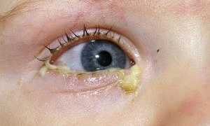 Особенность гнойного конъюнктивита: лечение патологии