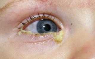 Особенность гнойного конъюнктивита: лечение патологии