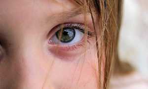 Обезболивание ячменя с помощью компрессов