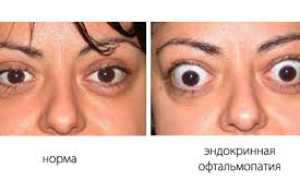 Методы лечения эндокринной офтальмопатии