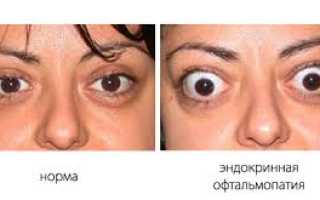 Методы лечения эндокринной офтальмопатии