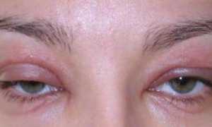 Аллергия на веках: формы, причины и лечение