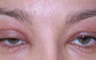 Аллергия на веках: формы, причины и лечение