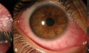 Демодекоз век