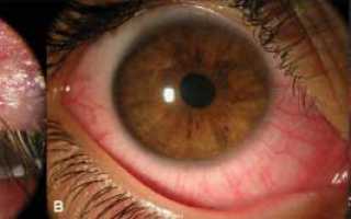 Демодекоз век