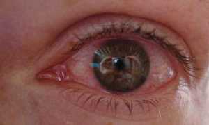 Профилактика вирусного конъюнктивита и лечение недуга