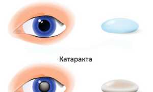 Лечение катаракты с помощью капель и таблеток