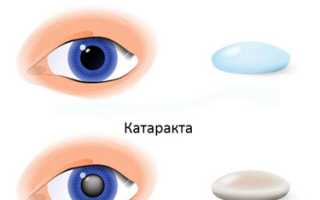 Лечение катаракты с помощью капель и таблеток