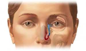 Как проявляется и лечится дакриоцистит у взрослых