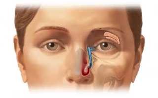 Как проявляется и лечится дакриоцистит у взрослых