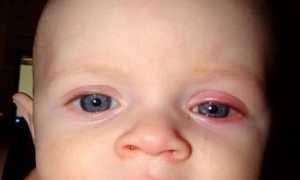 Конъюнктивит у грудничков, особенности лечения и диагностики