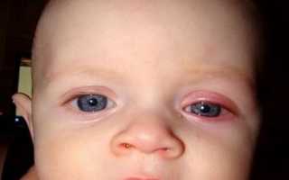 Конъюнктивит у грудничков, особенности лечения и диагностики