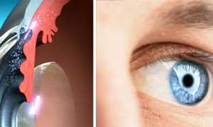 Виды глауком, методы диагностики и лечения