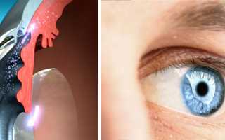 Виды глауком, методы диагностики и лечения