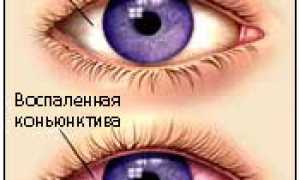 Показания к применению капель при детском конъюнктивите