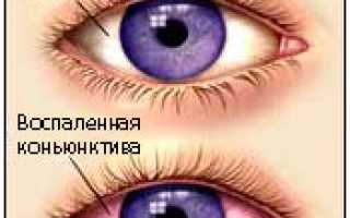 Показания к применению капель при детском конъюнктивите