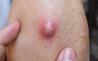 Как проявляется стафилококк у взрослых. Симптомы золотистого стафилококка