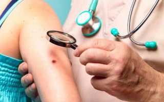 Заболевание крови меланома