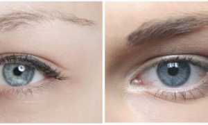 Какие заболевания можно распознать по глазам?