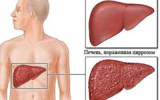 Причины и симптомы острого отравления этиловым спиртом
