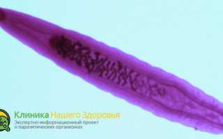 Сосальщики в организме человека