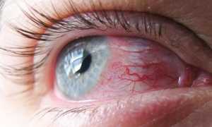 Классификация фолликулярного конъюнктивита