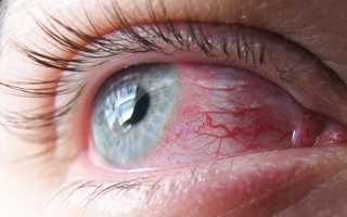 Классификация фолликулярного конъюнктивита