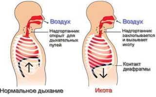 Икота после приема алкоголя: как от нее избавиться