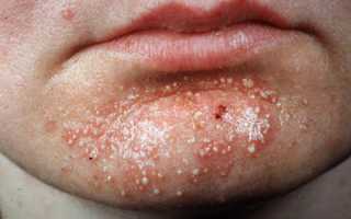 С чем может быть связан стафилококк на коже