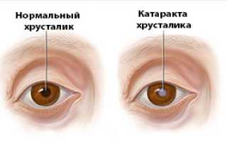 Клиническая картина катаракты, возможные осложнения