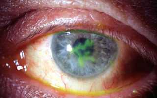 Можно ли носить очки и линзы во время глаукомы