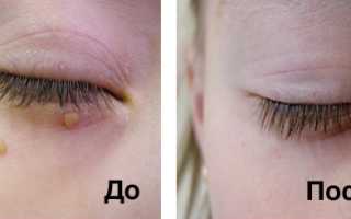 Лазерная деструкция папиллом