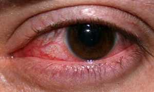 Можно ли кормить грудью во время конъюнктивита?