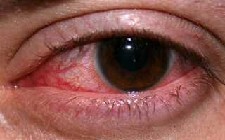 Можно ли кормить грудью во время конъюнктивита?