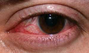 Дакриоцистит, что это такое?