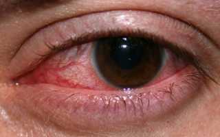 Дакриоцистит, что это такое?