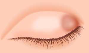 Народные способы лечения халязиона верхнего века