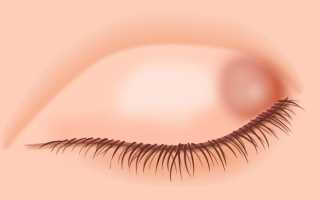 Народные способы лечения халязиона верхнего века