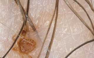 Как победить микроскопических паразитов: эффективные способы лечения лобкового педикулёза