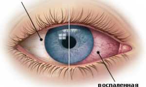 Причины возникновения распространенных глазных заболеваний