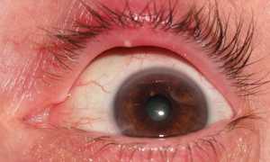 Ячмень, способы лечения и виды профилактики