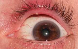 Ячмень, способы лечения и виды профилактики