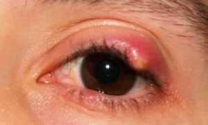 Лечение халязиона народными способами