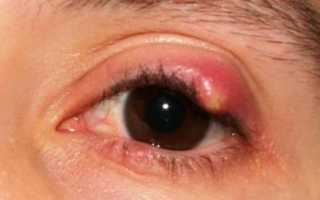 Лечение халязиона народными способами