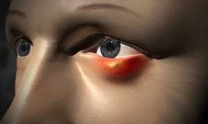 Тетрациклиновая мазь для лечения ячменя