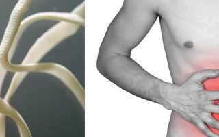 Как избавиться от ленточных глистов у человека? Способы лечения