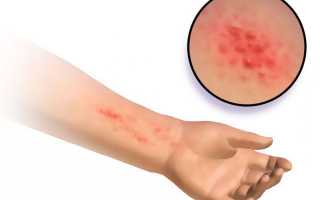 Шистосома гематобиум